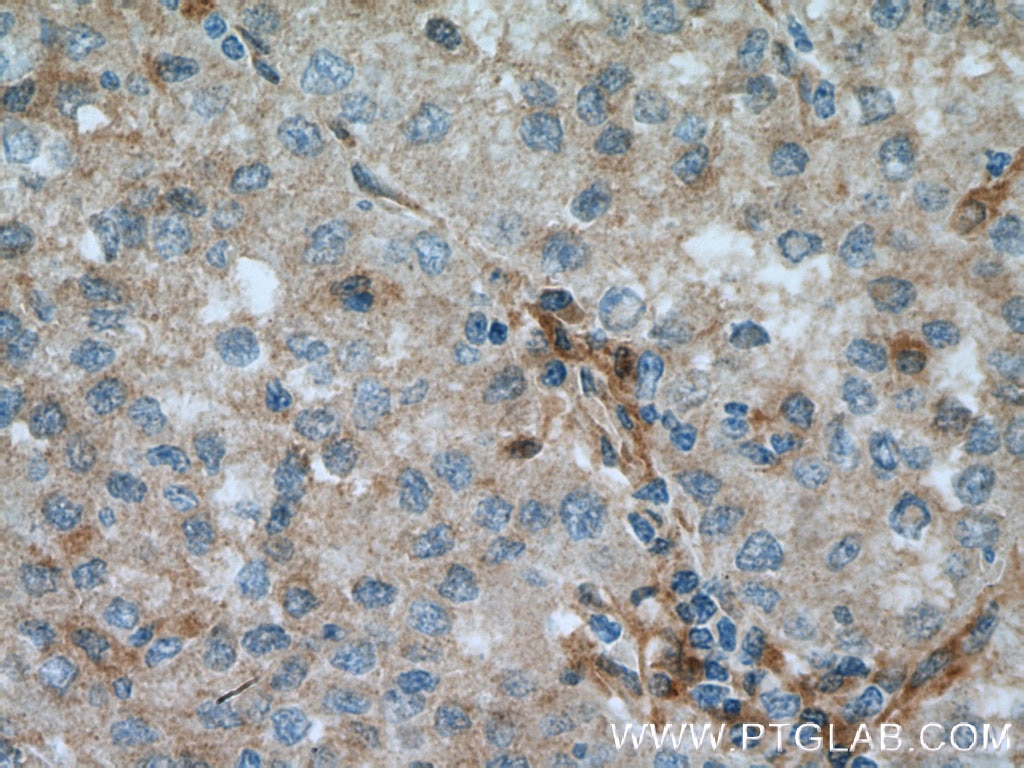 Immunohistochemistry (IHC) staining of human liver cancer tissue using PIG3 Polyclonal antibody (14828-1-AP)