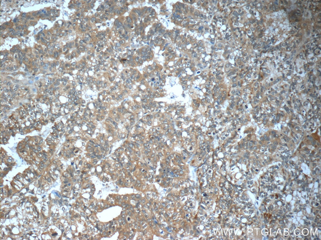 Immunohistochemistry (IHC) staining of human breast cancer tissue using TP53INP1 Polyclonal antibody (17872-1-AP)