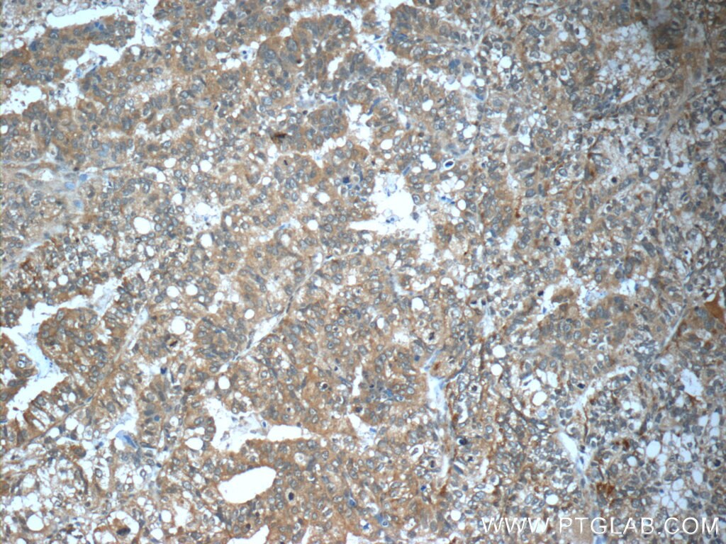 IHC staining of human breast cancer using 17872-1-AP