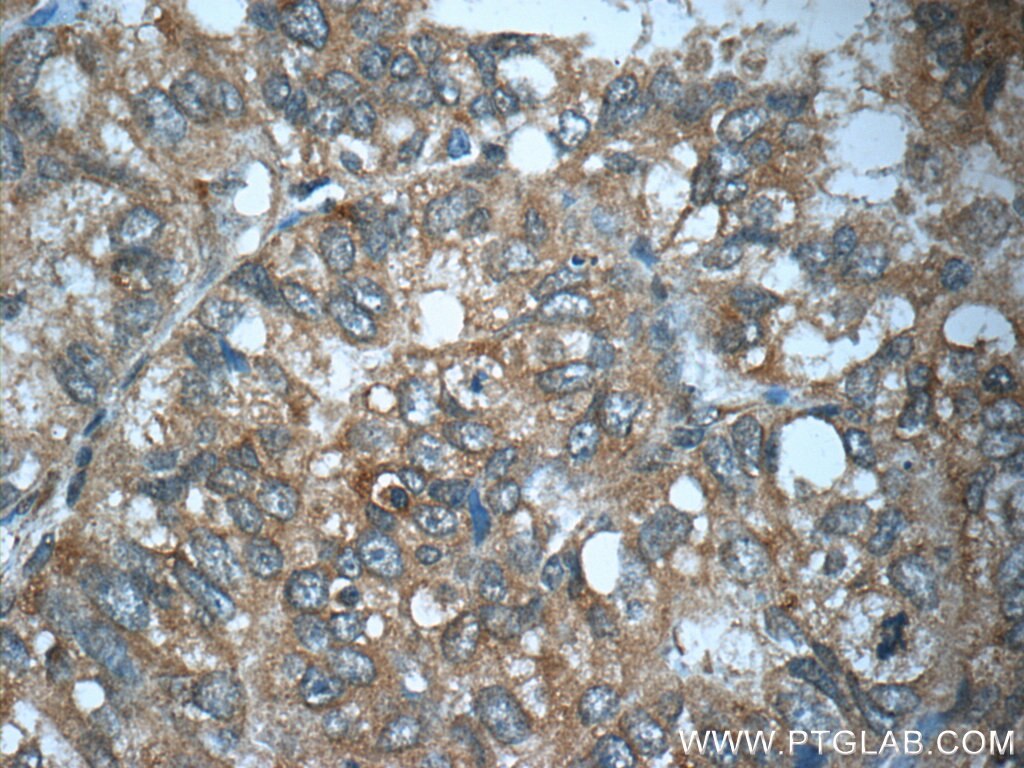 Immunohistochemistry (IHC) staining of human breast cancer tissue using TP53INP1 Polyclonal antibody (17872-1-AP)