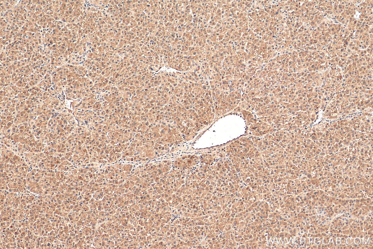 Immunohistochemistry (IHC) staining of human liver cancer tissue using TP53INP1 Polyclonal antibody (17872-1-AP)