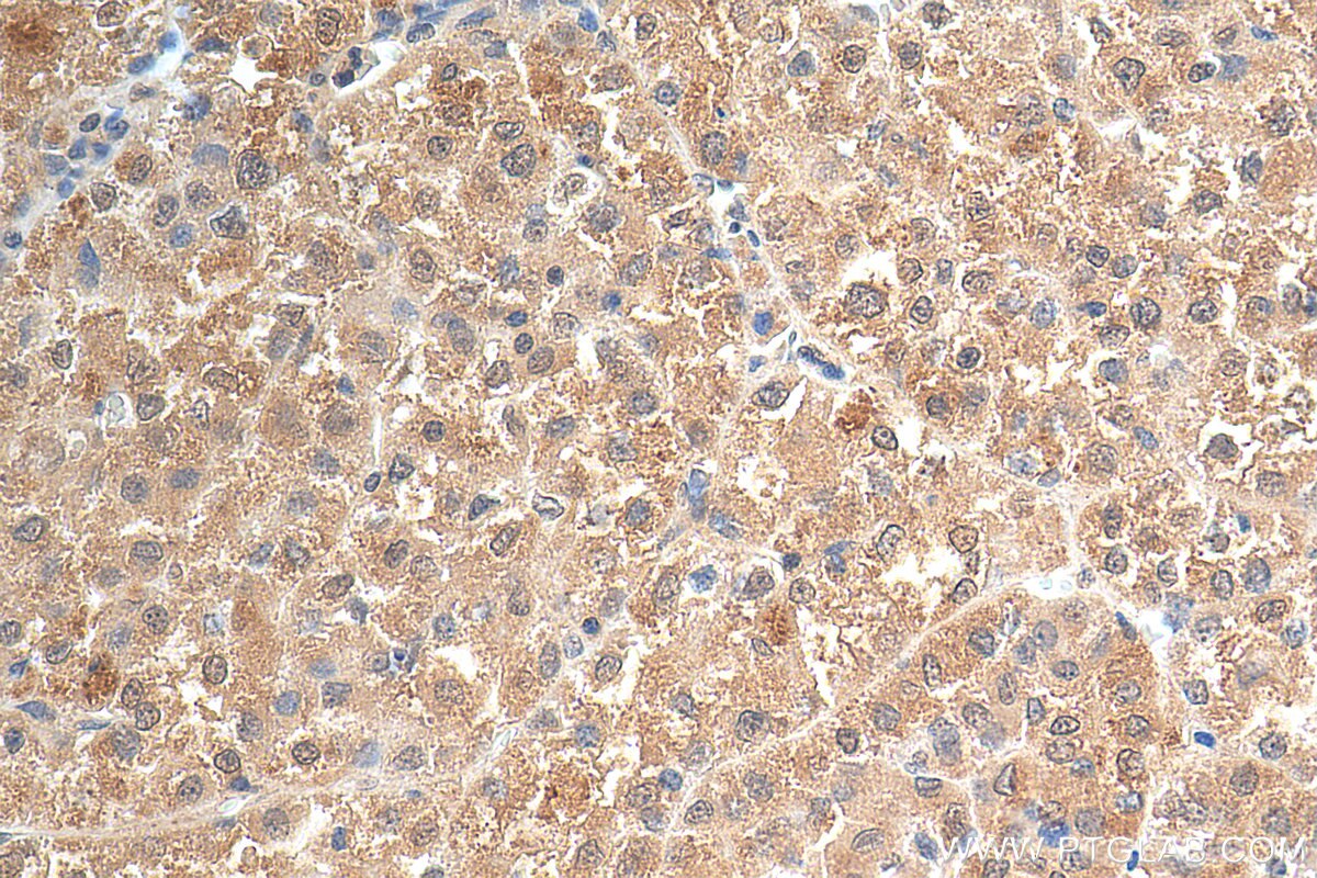 Immunohistochemistry (IHC) staining of human liver cancer tissue using TP53INP1 Polyclonal antibody (17872-1-AP)