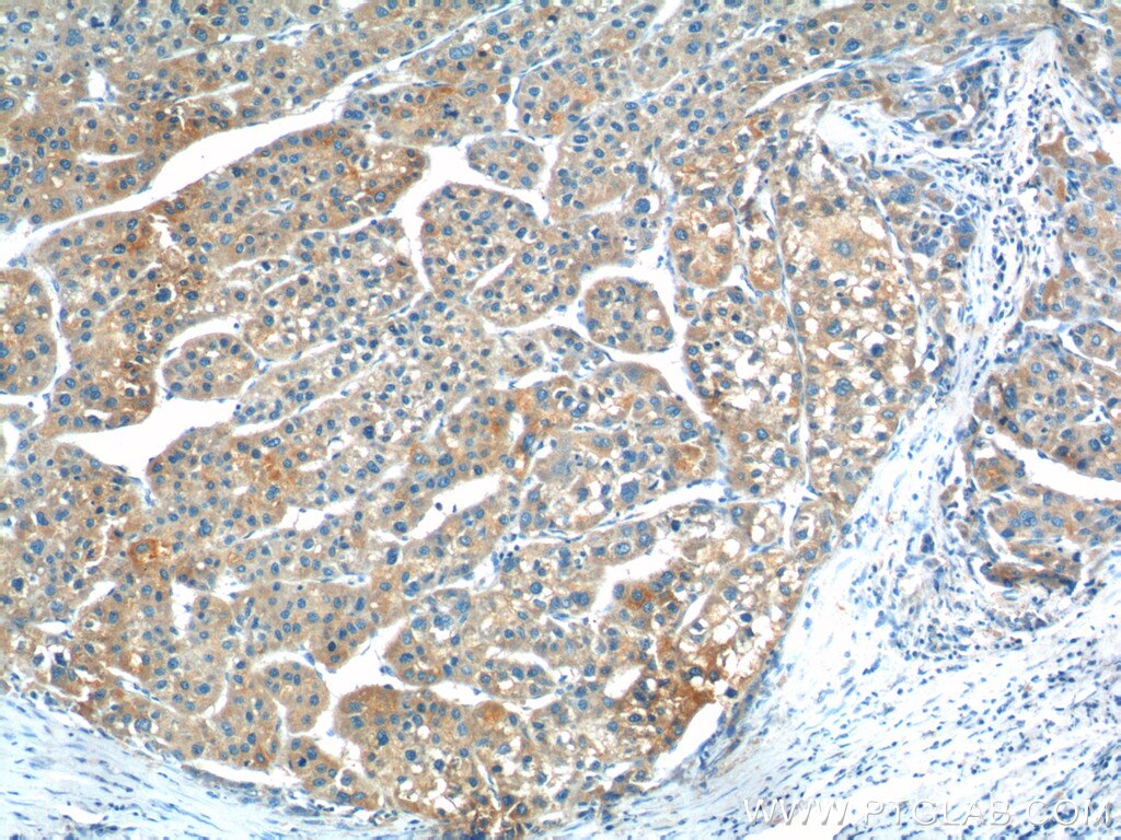 Immunohistochemistry (IHC) staining of human liver cancer tissue using TP53INP1 Polyclonal antibody (17872-1-AP)