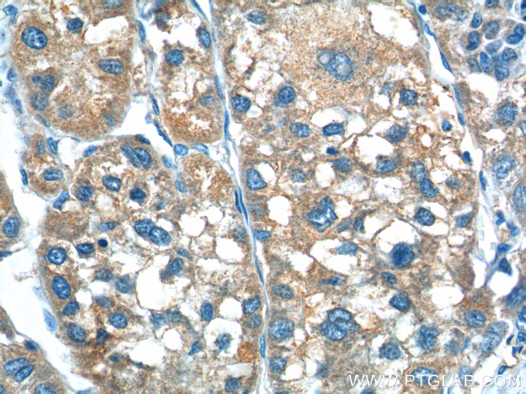 Immunohistochemistry (IHC) staining of human liver cancer tissue using TP53INP1 Polyclonal antibody (17872-1-AP)