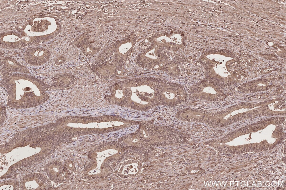 Immunohistochemistry (IHC) staining of human rectal cancer tissue using TP53INP1 Polyclonal antibody (17872-1-AP)