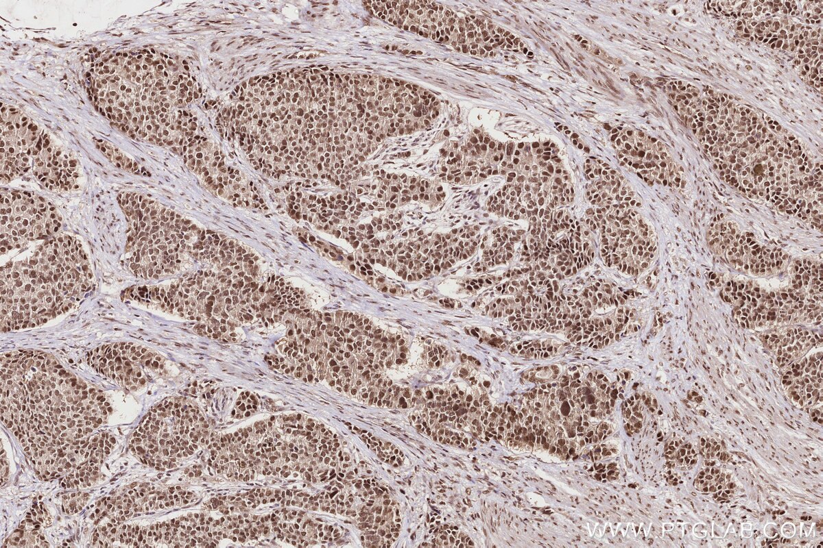 Immunohistochemistry (IHC) staining of human stomach cancer tissue using TP53RK Polyclonal antibody (26818-1-AP)