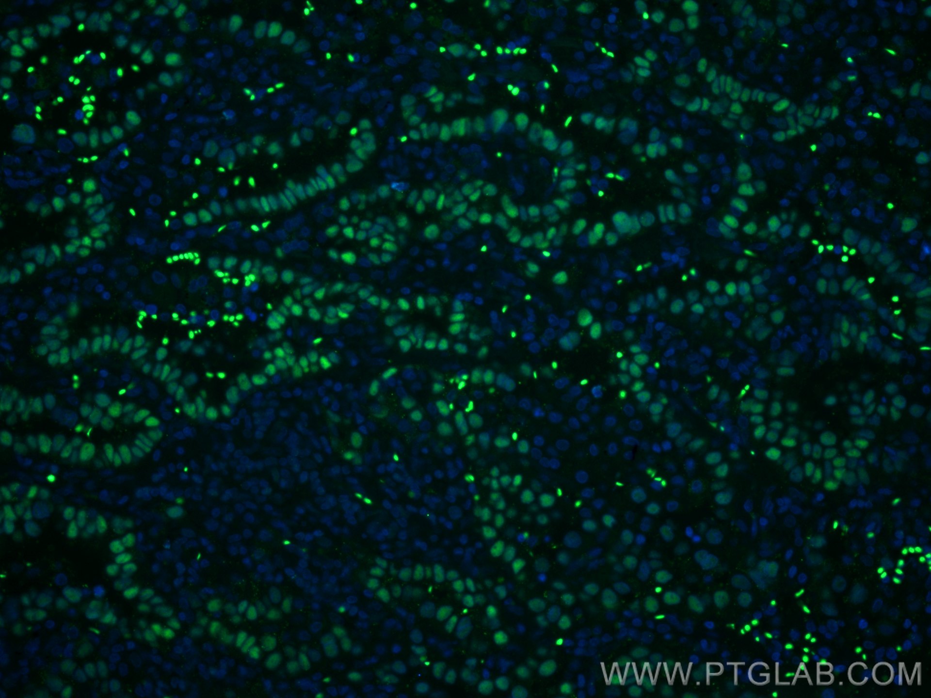 Immunofluorescence (IF) / fluorescent staining of human lung cancer tissue using p63 Polyclonal antibody (12143-1-AP)
