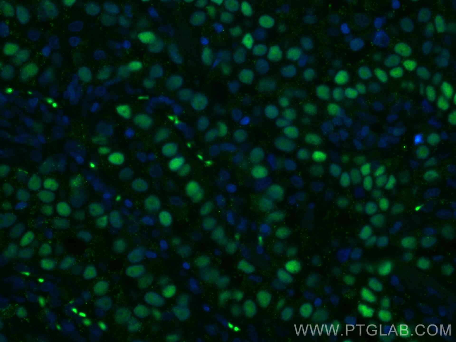 Immunofluorescence (IF) / fluorescent staining of human lung cancer tissue using p63 Polyclonal antibody (12143-1-AP)