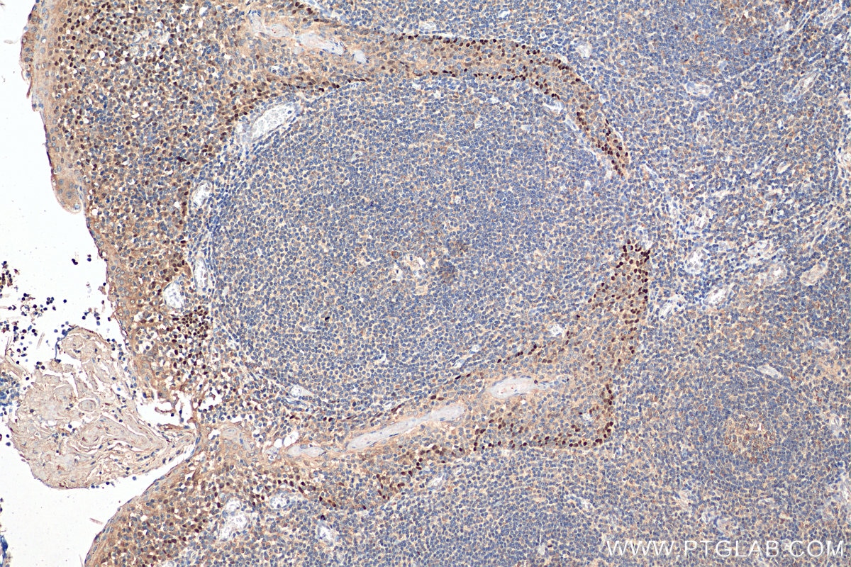 Immunohistochemistry (IHC) staining of human tonsillitis tissue using p63 Polyclonal antibody (12143-1-AP)