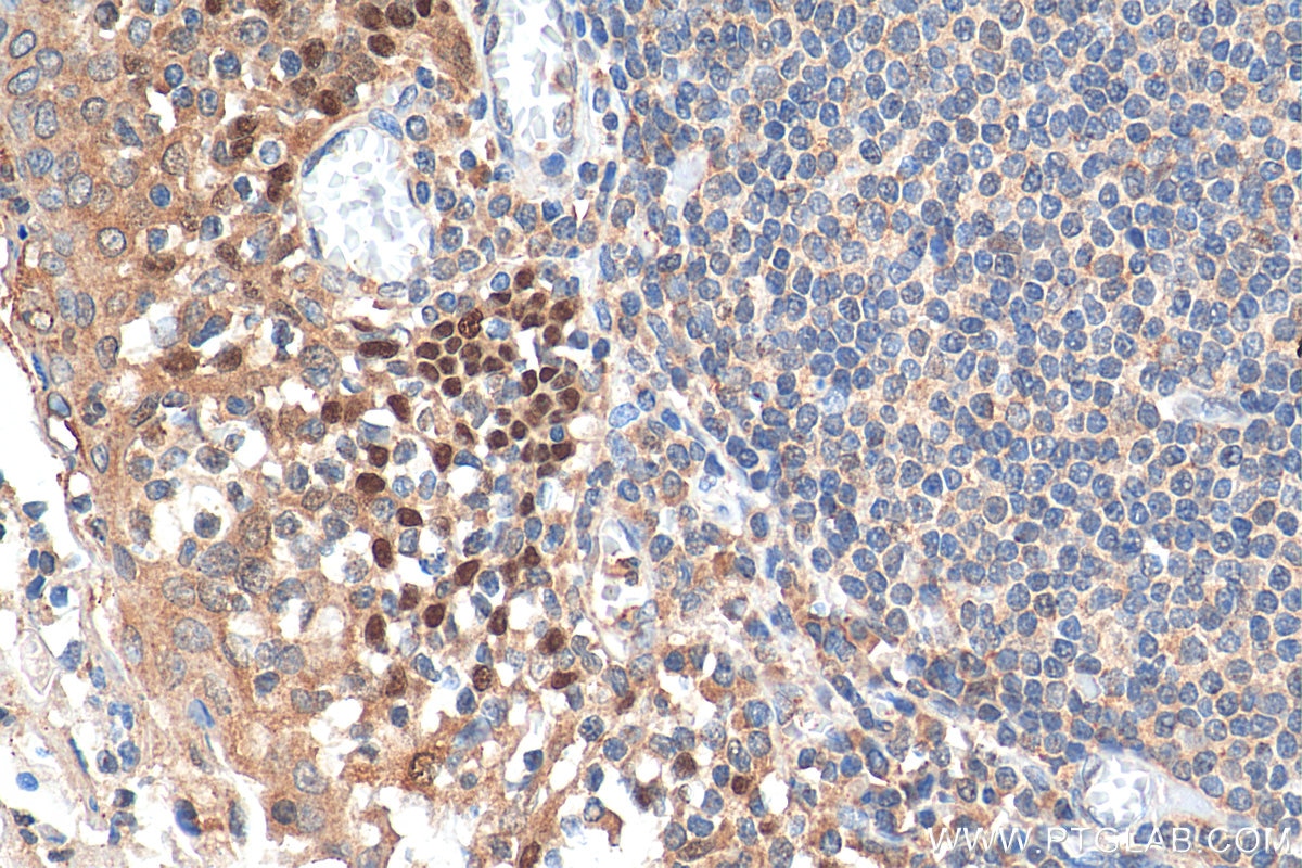 Immunohistochemistry (IHC) staining of human tonsillitis tissue using p63 Polyclonal antibody (12143-1-AP)