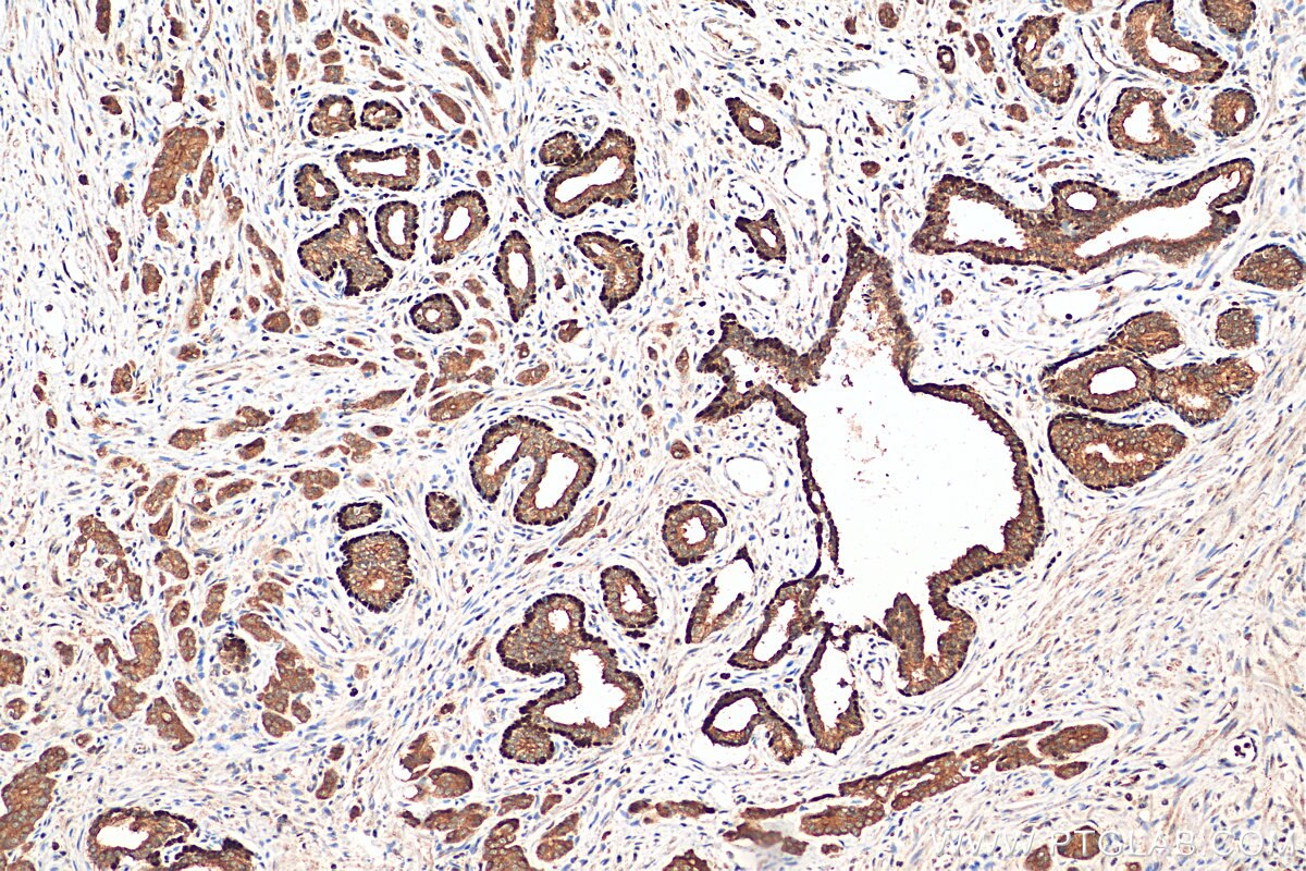 IHC staining of human prostate cancer using 12143-1-AP