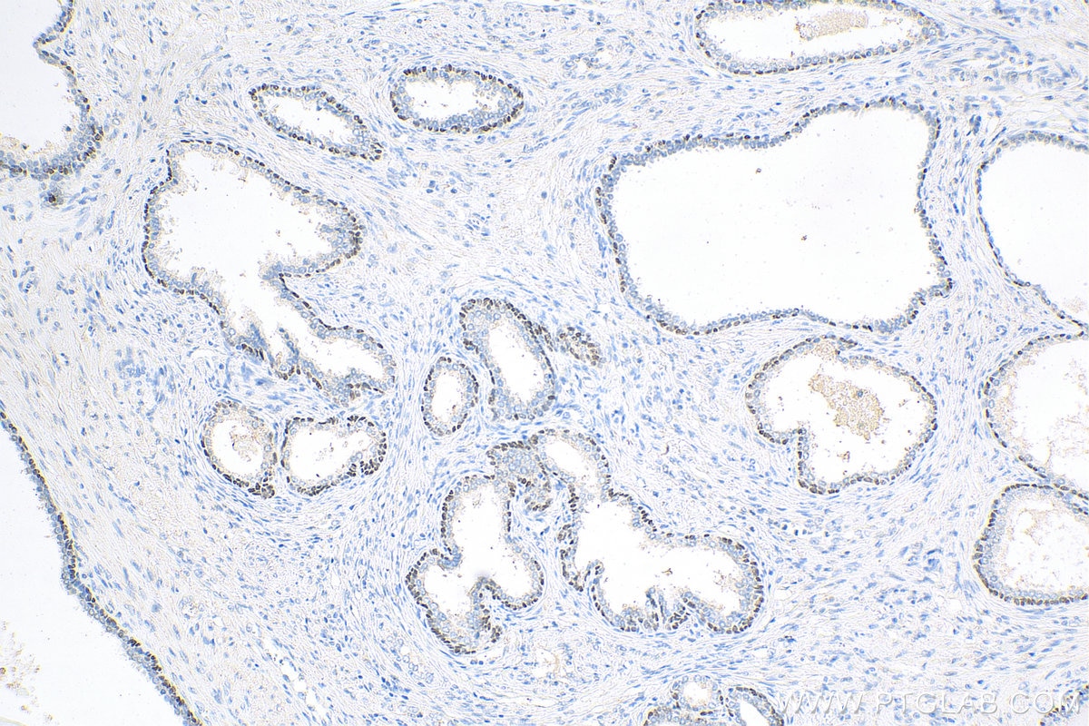 Immunohistochemistry (IHC) staining of human prostate cancer tissue using p63 Polyclonal antibody (12143-1-AP)