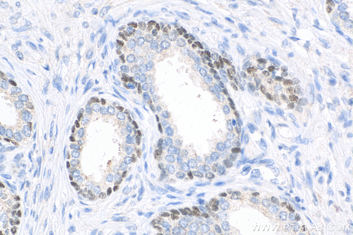Immunohistochemistry (IHC) staining of human prostate cancer tissue using p63 Polyclonal antibody (12143-1-AP)
