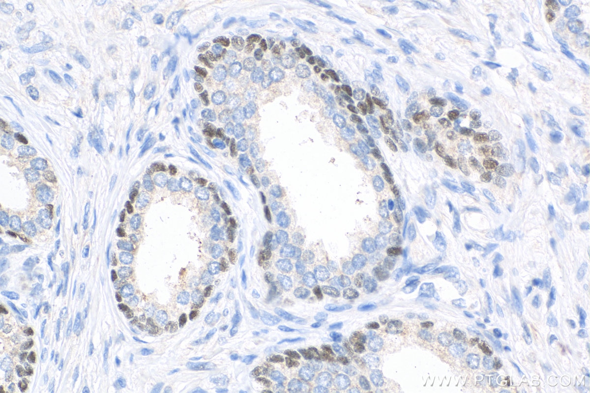 IHC staining of human prostate cancer using 12143-1-AP