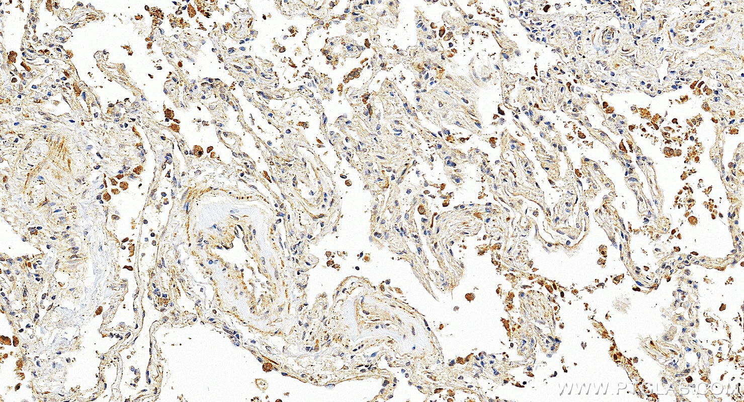 Immunohistochemical analysis of paraffin-embedded human lung cancer tissue slide using 12143-1-AP (p63 antibody) at dilution of 1:4000 (under 20x lens). Heat mediated antigen retrieval with Tris-EDTA buffer (pH 9.0). Immunohistochemistry (IHC) staining of human lung cancer tissue using p63 Polyclonal antibody (12143-1-AP)