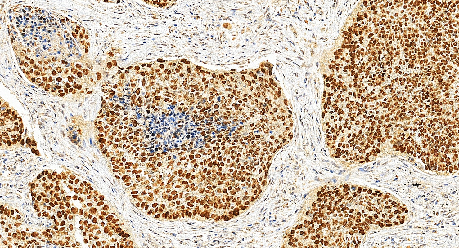 Immunohistochemical analysis of paraffin-embedded human lung cancer tissue slide using 12143-1-AP (p63 antibody) at dilution of 1:4000 (under 20x lens). Heat mediated antigen retrieval with Tris-EDTA buffer (pH 9.0). Immunohistochemistry (IHC) staining of human lung cancer tissue using p63 Polyclonal antibody (12143-1-AP)
