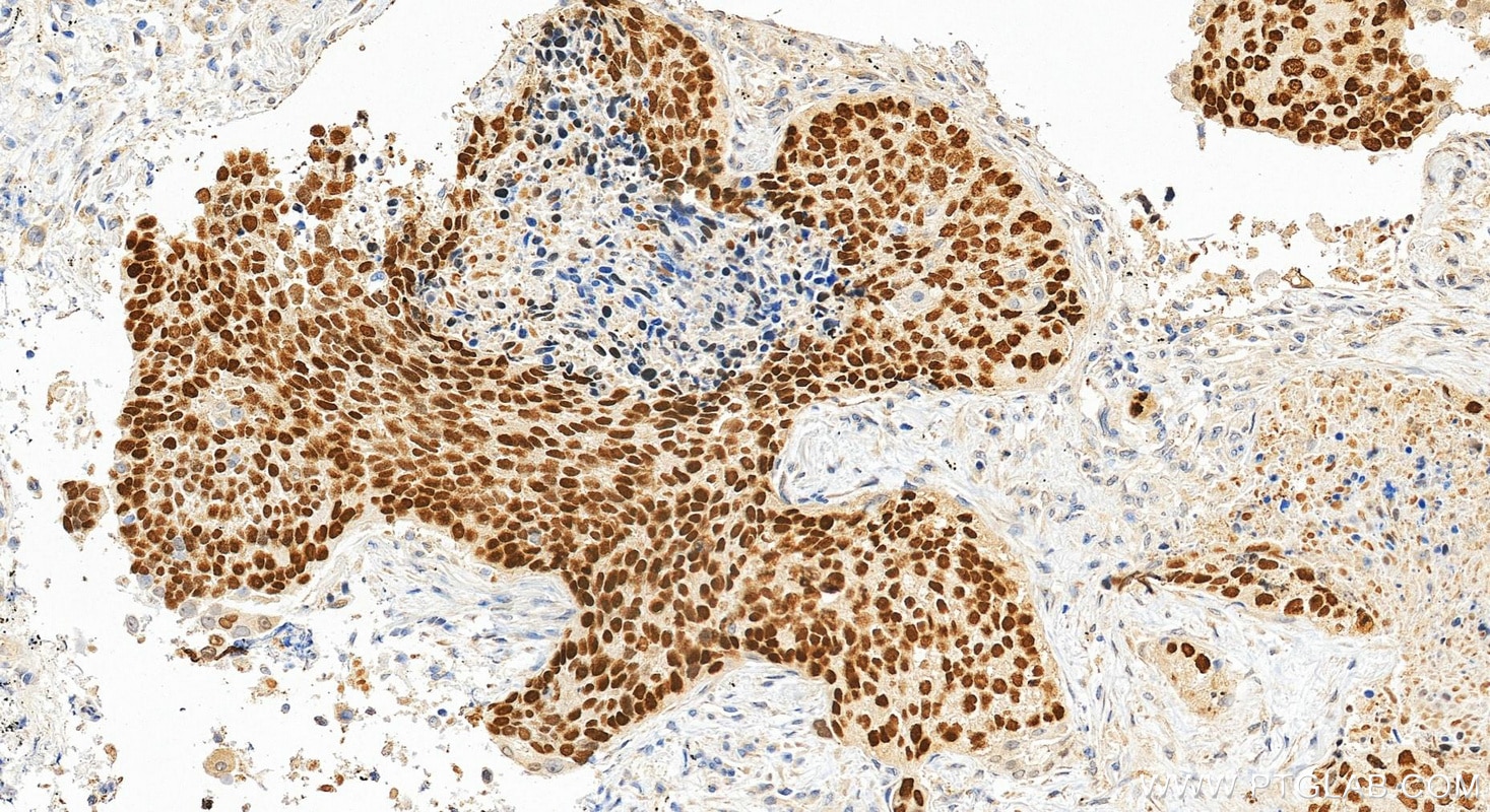 Immunohistochemical analysis of paraffin-embedded human lung cancer tissue slide using 12143-1-AP (p63 antibody) at dilution of 1:4000 (under 20x lens). Heat mediated antigen retrieval with Tris-EDTA buffer (pH 9.0). Immunohistochemistry (IHC) staining of human lung cancer tissue using p63 Polyclonal antibody (12143-1-AP)