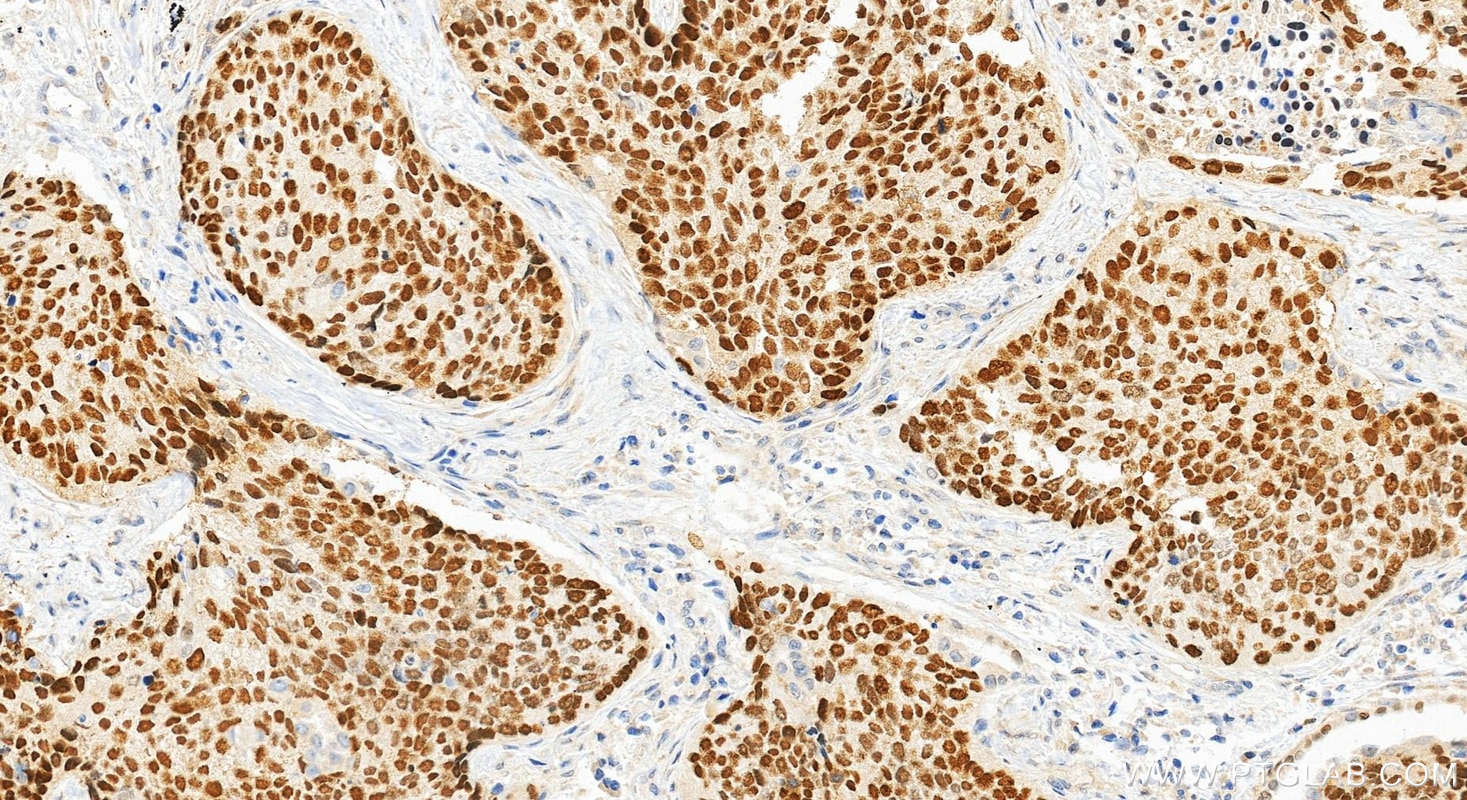 Immunohistochemical analysis of paraffin-embedded human lung cancer tissue slide using 12143-1-AP (p63 antibody) at dilution of 1:4000 (under 20x lens). Heat mediated antigen retrieval with Tris-EDTA buffer (pH 9.0). Immunohistochemistry (IHC) staining of human lung cancer tissue using p63 Polyclonal antibody (12143-1-AP)