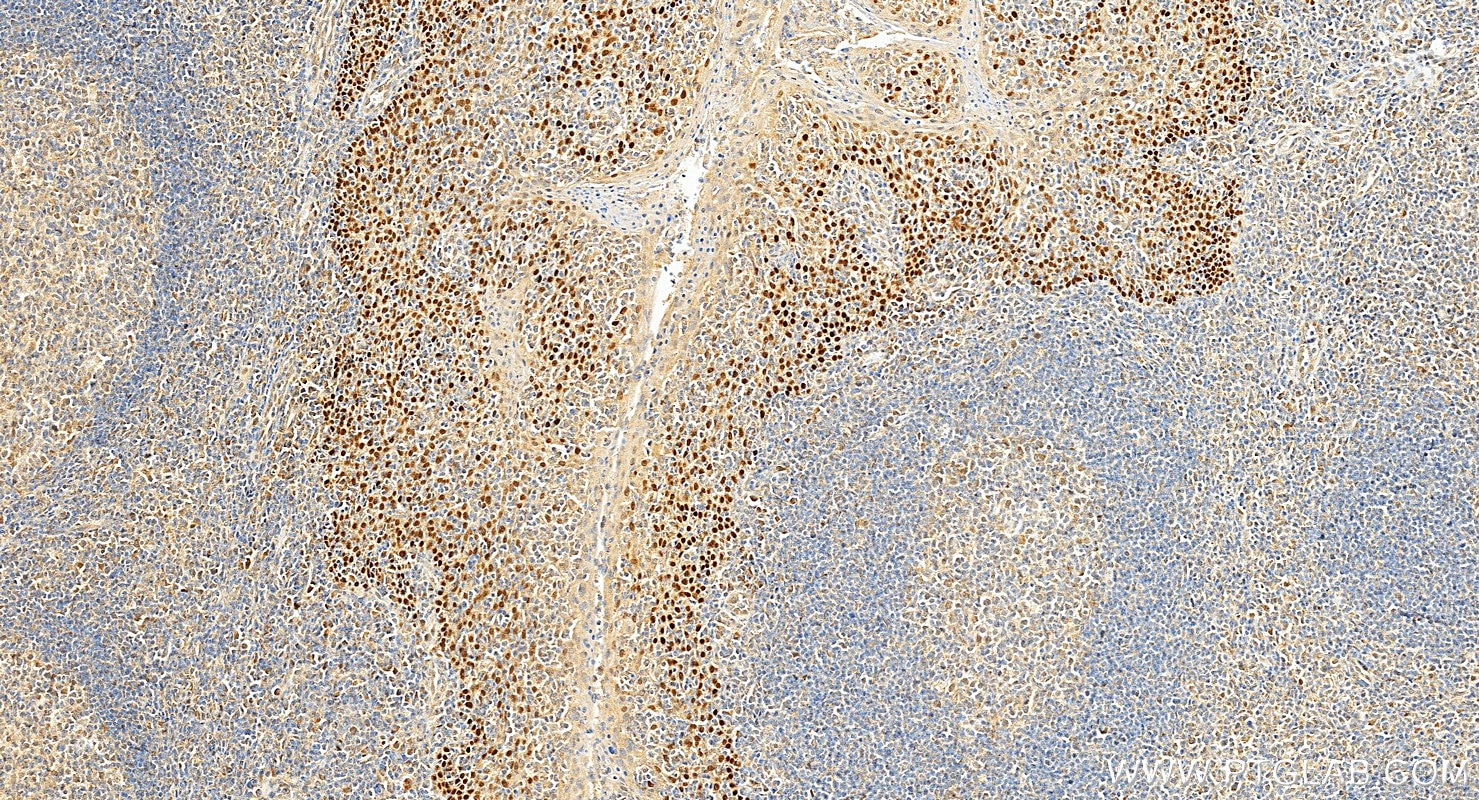 Immunohistochemical analysis of paraffin-embedded human tonsillitis tissue slide using 12143-1-AP (p63 antibody) at dilution of 1:2000 (under 20x lens). Heat mediated antigen retrieval with Tris-EDTA buffer (pH 9.0). Immunohistochemistry (IHC) staining of human tonsillitis tissue using p63 Polyclonal antibody (12143-1-AP)