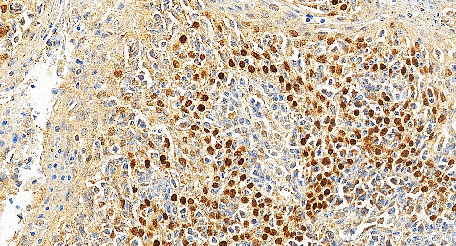 Immunohistochemical analysis of paraffin-embedded human tonsillitis tissue slide using 12143-1-AP (p63 antibody) at dilution of 1:2000 (under 20x lens). Heat mediated antigen retrieval with Tris-EDTA buffer (pH 9.0). Immunohistochemistry (IHC) staining of human tonsillitis tissue using p63 Polyclonal antibody (12143-1-AP)