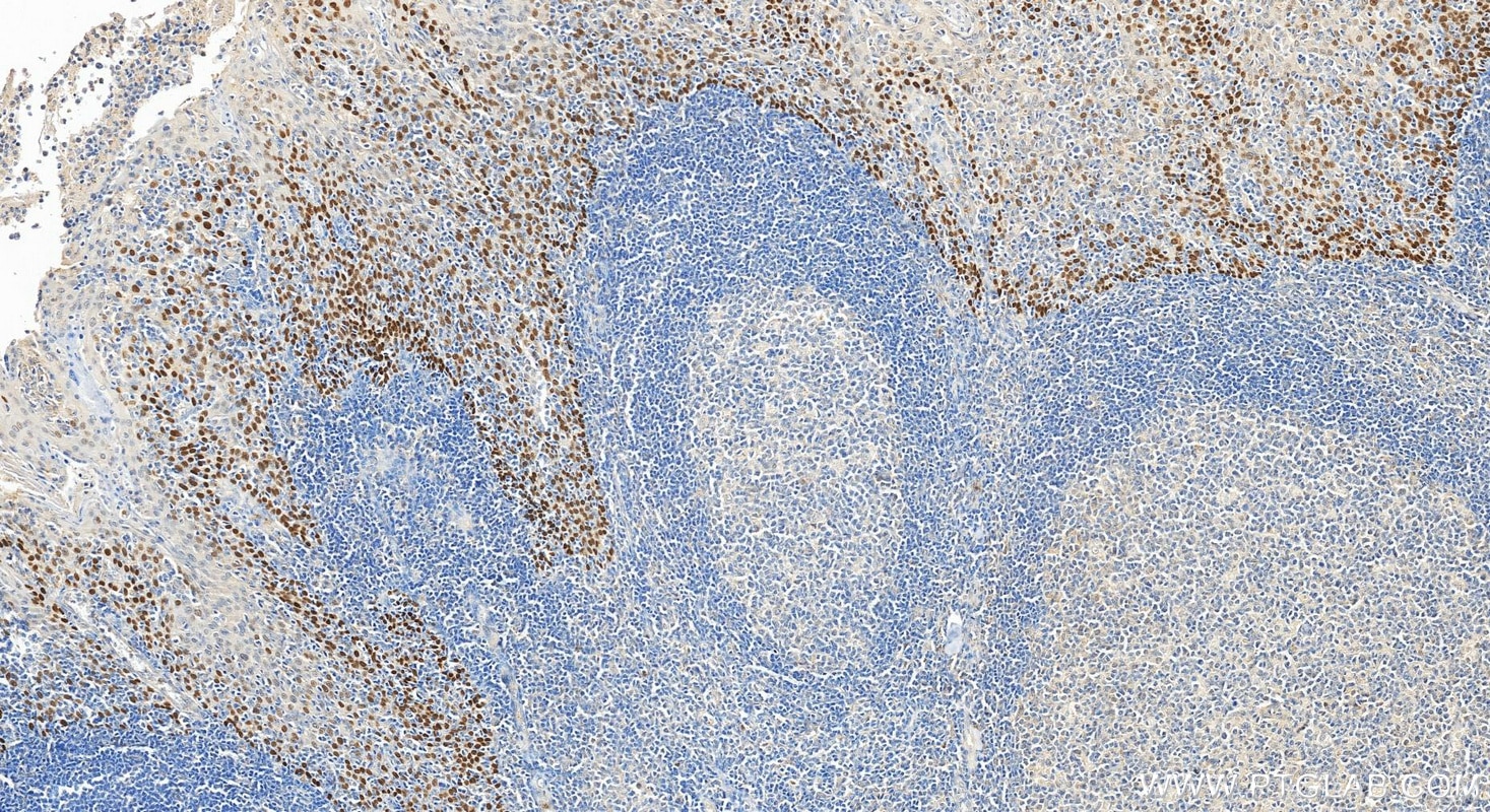 Immunohistochemical analysis of paraffin-embedded human tonsillitis tissue slide using 12143-1-AP (p63 antibody) at dilution of 1:4000 (under 20x lens). Heat mediated antigen retrieval with Tris-EDTA buffer (pH 9.0). Immunohistochemistry (IHC) staining of human tonsillitis tissue using p63 Polyclonal antibody (12143-1-AP)
