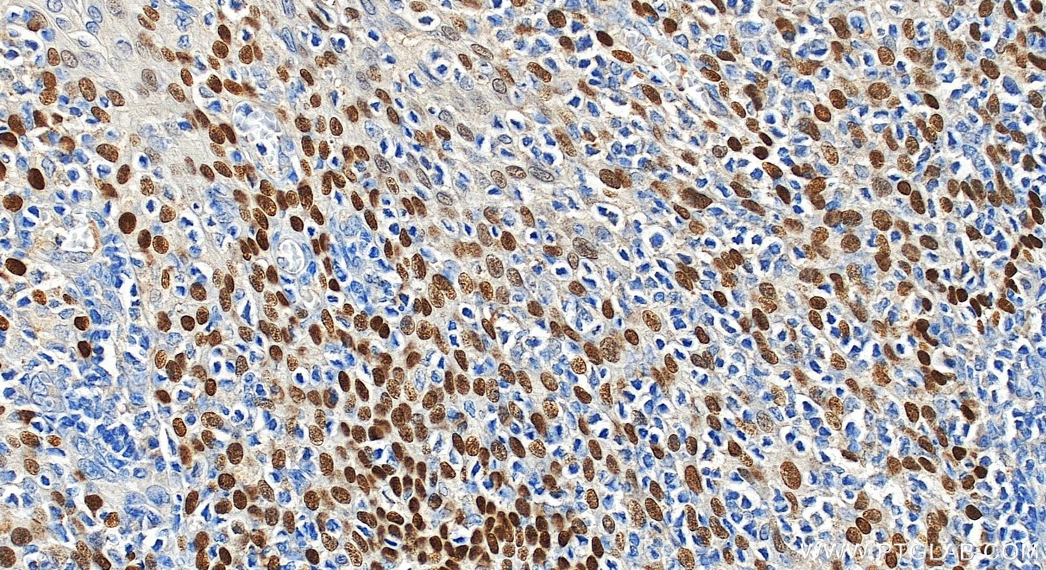 Immunohistochemical analysis of paraffin-embedded human tonsillitis tissue slide using 12143-1-AP (p63 antibody) at dilution of 1:4000 (under 20x lens). Heat mediated antigen retrieval with Tris-EDTA buffer (pH 9.0). Immunohistochemistry (IHC) staining of human tonsillitis tissue using p63 Polyclonal antibody (12143-1-AP)