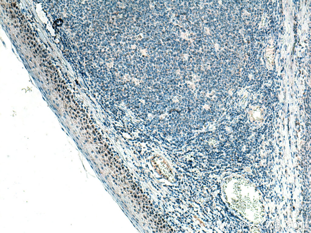 Immunohistochemistry (IHC) staining of human tonsillitis tissue using p63 Monoclonal antibody (60332-1-Ig)