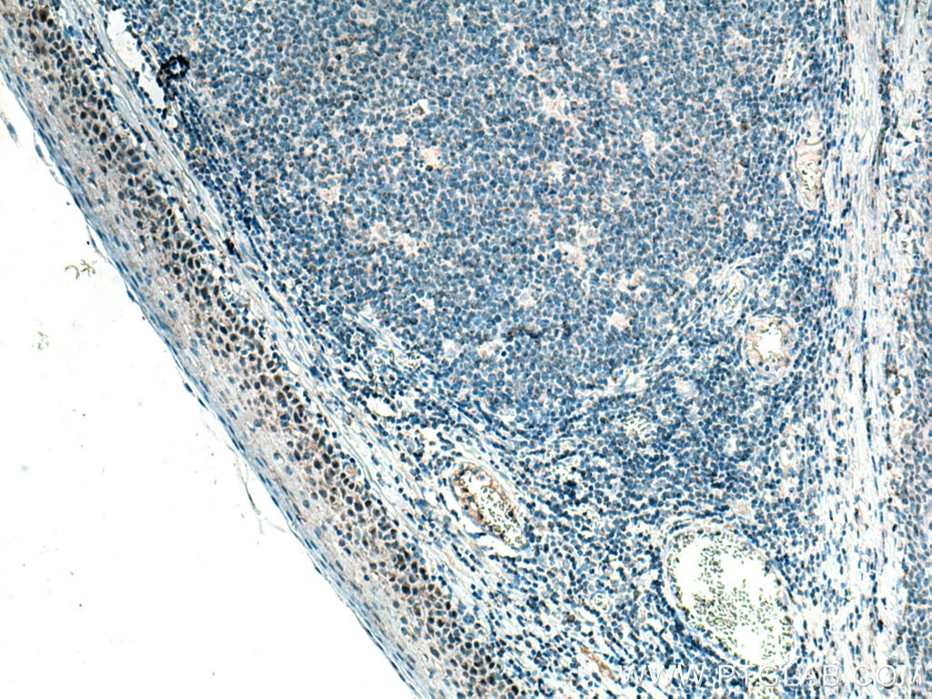 IHC staining of human tonsillitis using 60332-1-Ig