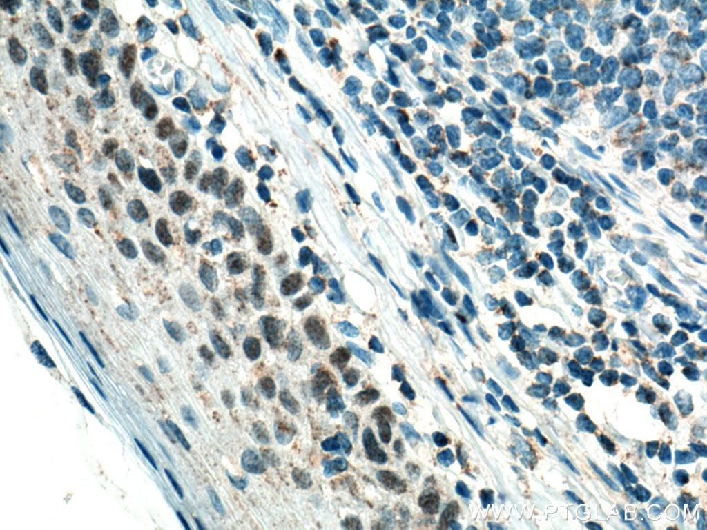 IHC staining of human tonsillitis using 60332-1-Ig