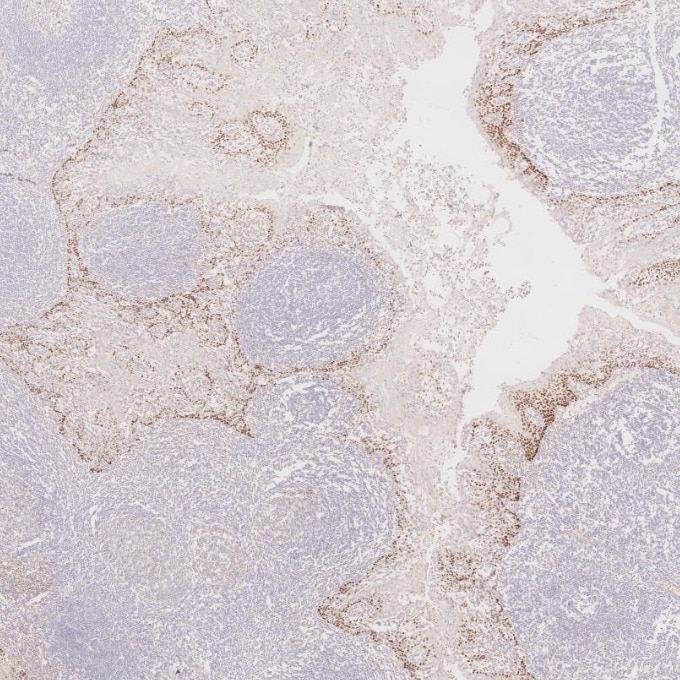 IHC staining of human tonsillitis using 60332-2-Ig Immunohistochemistry (IHC) staining of human tonsillitis tissue using p63 Monoclonal antibody (60332-2-Ig)