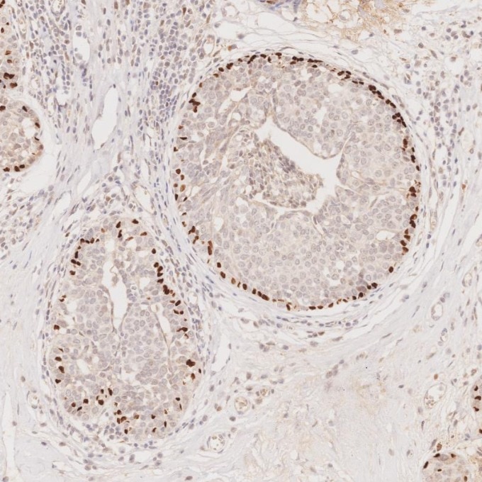IHC staining of human breast cancer using 60332-2-Ig Immunohistochemistry (IHC) staining of human breast cancer tissue using p63 Monoclonal antibody (60332-2-Ig)