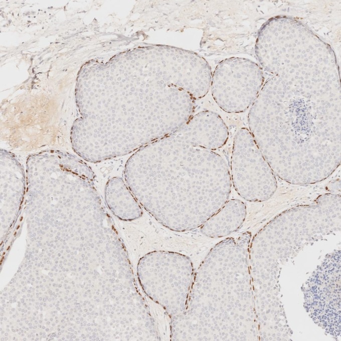 IHC staining of human breast cancer using 60332-2-Ig Immunohistochemistry (IHC) staining of human breast cancer tissue using p63 Monoclonal antibody (60332-2-Ig)