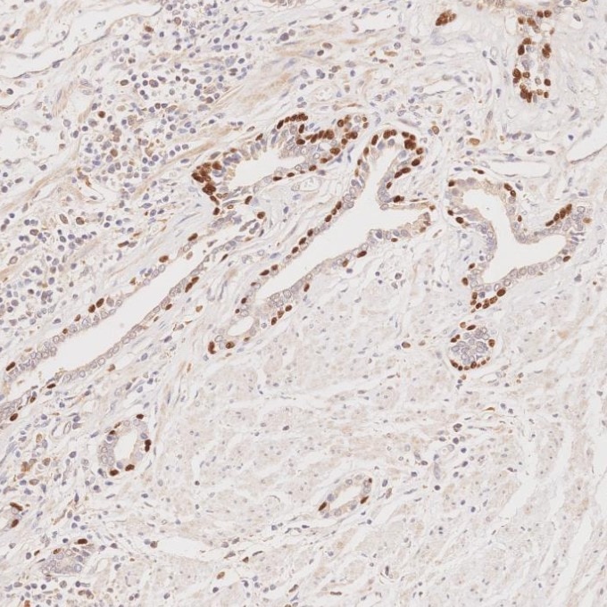 IHC staining of human prostate cancer using 60332-2-Ig Immunohistochemistry (IHC) staining of human prostate cancer tissue using p63 Monoclonal antibody (60332-2-Ig)