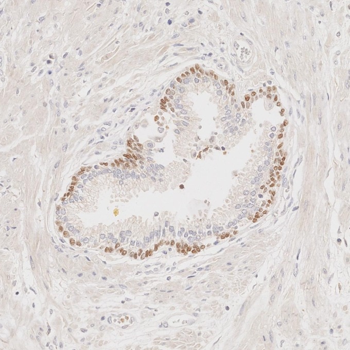 IHC staining of human prostate cancer using 60332-2-Ig Immunohistochemistry (IHC) staining of human prostate cancer tissue using p63 Monoclonal antibody (60332-2-Ig)