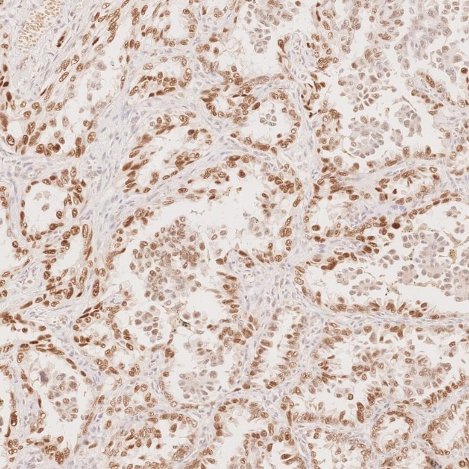 IHC staining of human lung cancer using 60332-2-Ig Immunohistochemistry (IHC) staining of human lung cancer tissue using p63 Monoclonal antibody (60332-2-Ig)