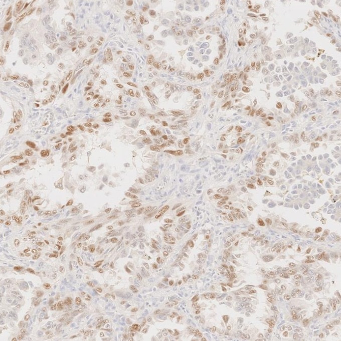 IHC staining of human lung cancer using 60332-2-Ig Immunohistochemistry (IHC) staining of human lung cancer tissue using p63 Monoclonal antibody (60332-2-Ig)