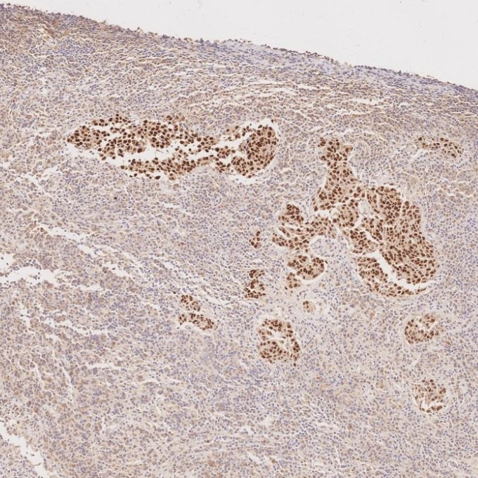 IHC staining of human nasopharyngeal carcinoma using 60332-2-Ig Immunohistochemistry (IHC) staining of human nasopharyngeal carcinoma tissue using p63 Monoclonal antibody (60332-2-Ig)