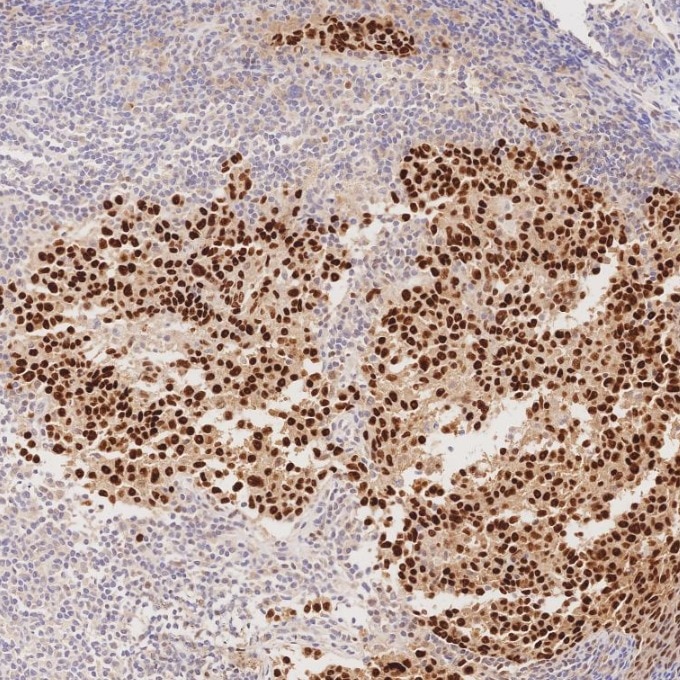 IHC staining of human nasopharyngeal carcinoma using 86154-1-RR Immunohistochemistry (IHC) staining of human nasopharyngeal carcinoma tissue using TP63 Recombinant monoclonal antibody (86154-1-RR)