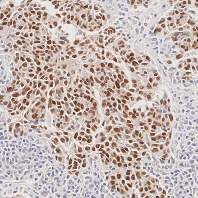IHC staining of human nasopharyngeal carcinoma using 86154-1-RR Immunohistochemistry (IHC) staining of human nasopharyngeal carcinoma tissue using TP63 Recombinant monoclonal antibody (86154-1-RR)