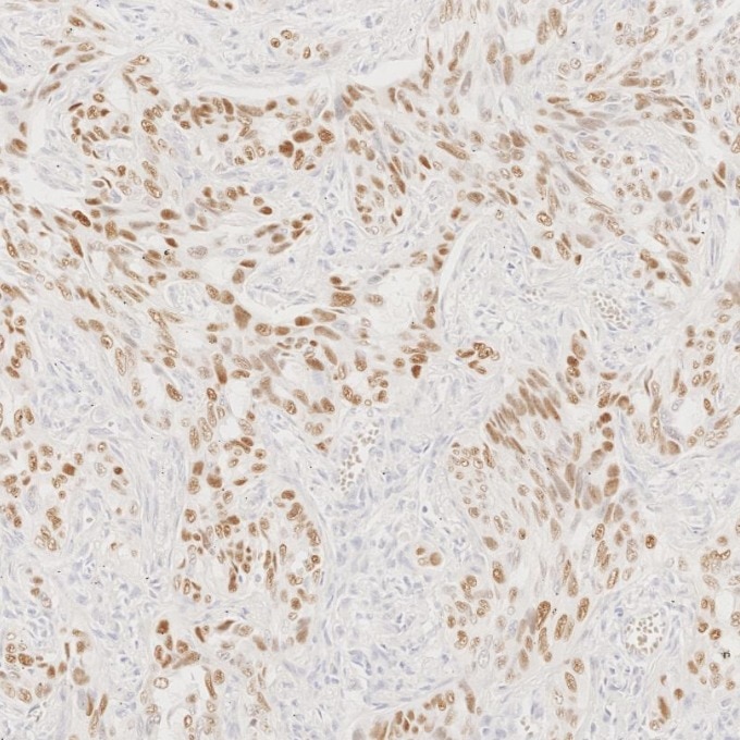 IHC staining of human lung cancer using 86154-1-RR Immunohistochemistry (IHC) staining of human lung cancer tissue using TP63 Recombinant monoclonal antibody (86154-1-RR)