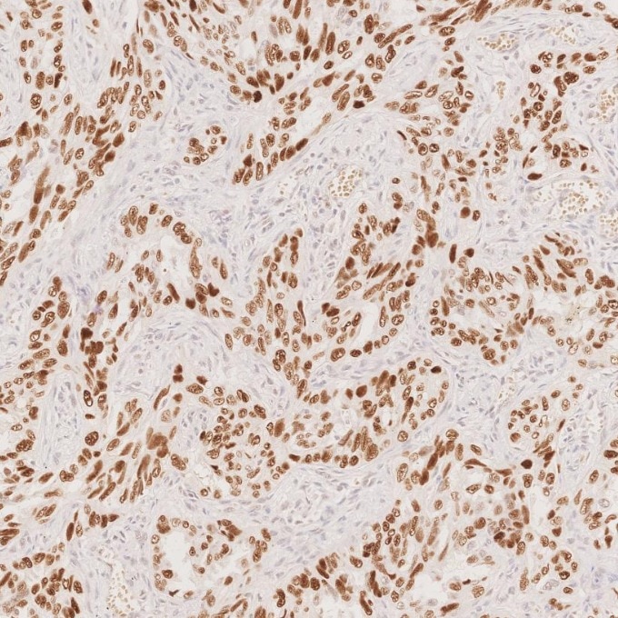 IHC staining of human lung cancer using 86154-1-RR Immunohistochemistry (IHC) staining of human lung cancer tissue using TP63 Recombinant monoclonal antibody (86154-1-RR)