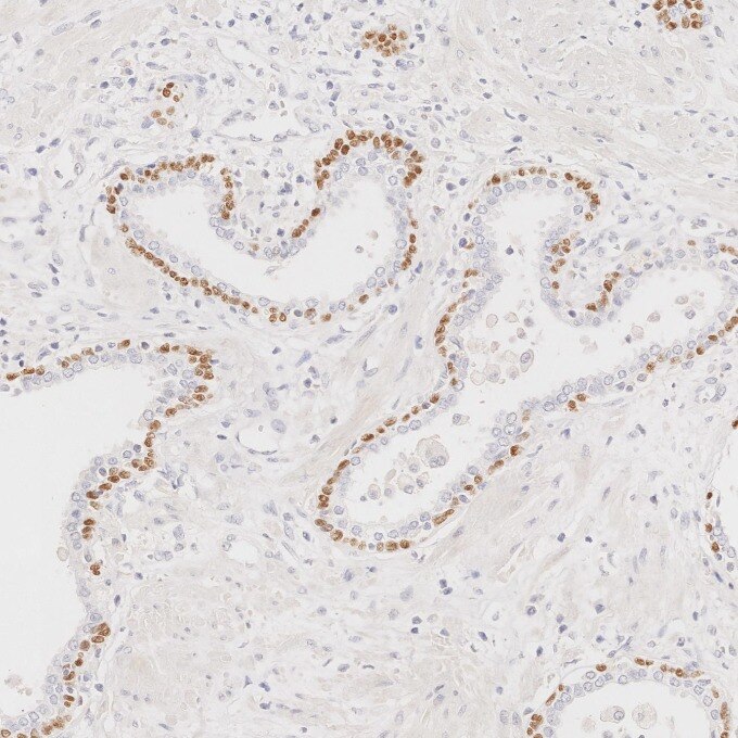 IHC staining of human prostate cancer using 86154-1-RR Immunohistochemistry (IHC) staining of human prostate cancer tissue using TP63 Recombinant monoclonal antibody (86154-1-RR)