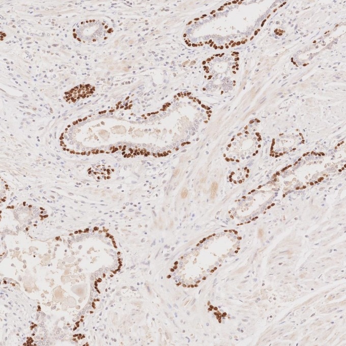 IHC staining of human prostate cancer using 86154-1-RR Immunohistochemistry (IHC) staining of human prostate cancer tissue using TP63 Recombinant monoclonal antibody (86154-1-RR)