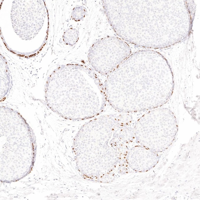IHC staining of human breast cancer using 86154-1-RR Immunohistochemistry (IHC) staining of human breast cancer tissue using TP63 Recombinant monoclonal antibody (86154-1-RR)