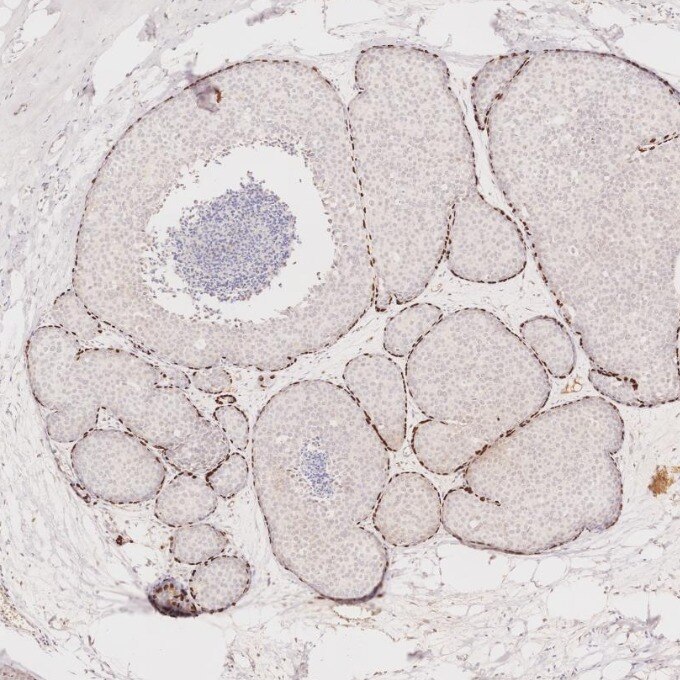 IHC staining of human breast cancer using 86154-1-RR Immunohistochemistry (IHC) staining of human breast cancer tissue using TP63 Recombinant monoclonal antibody (86154-1-RR)