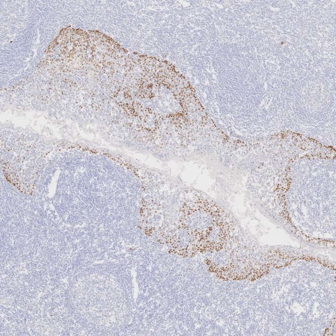 IHC staining of human tonsillitis using 86154-1-RR Immunohistochemistry (IHC) staining of human tonsillitis tissue using TP63 Recombinant monoclonal antibody (86154-1-RR)