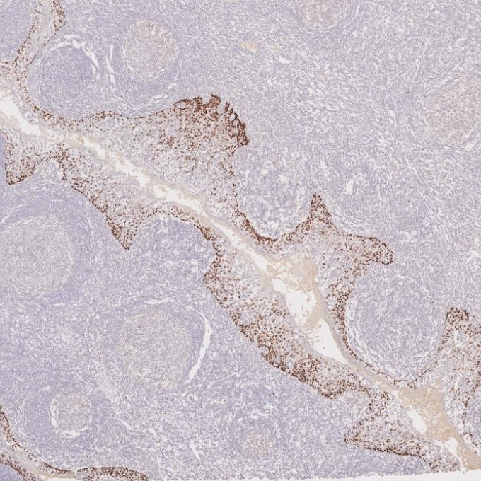 IHC staining of human tonsillitis using 86154-1-RR Immunohistochemistry (IHC) staining of human tonsillitis tissue using TP63 Recombinant monoclonal antibody (86154-1-RR)
