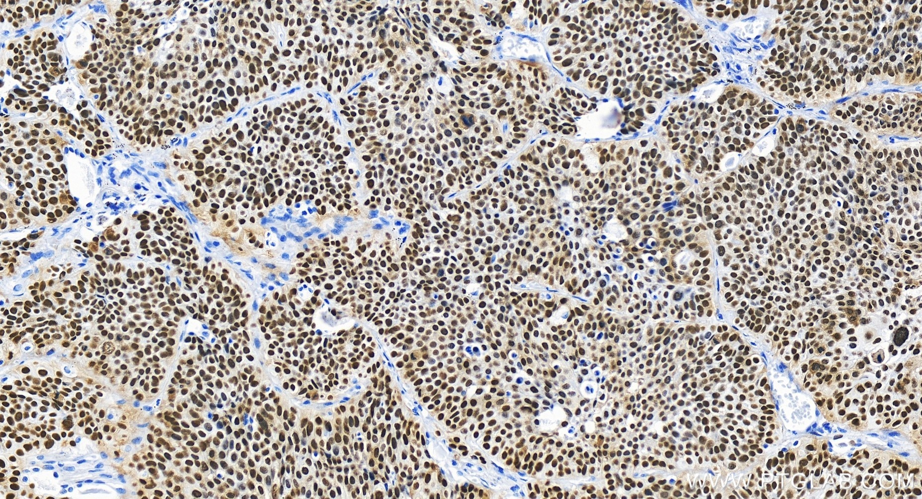 Immunohistochemistry (IHC) staining of human lung cancer tissue using TP63 Recombinant antibody (86154-1-RR)
