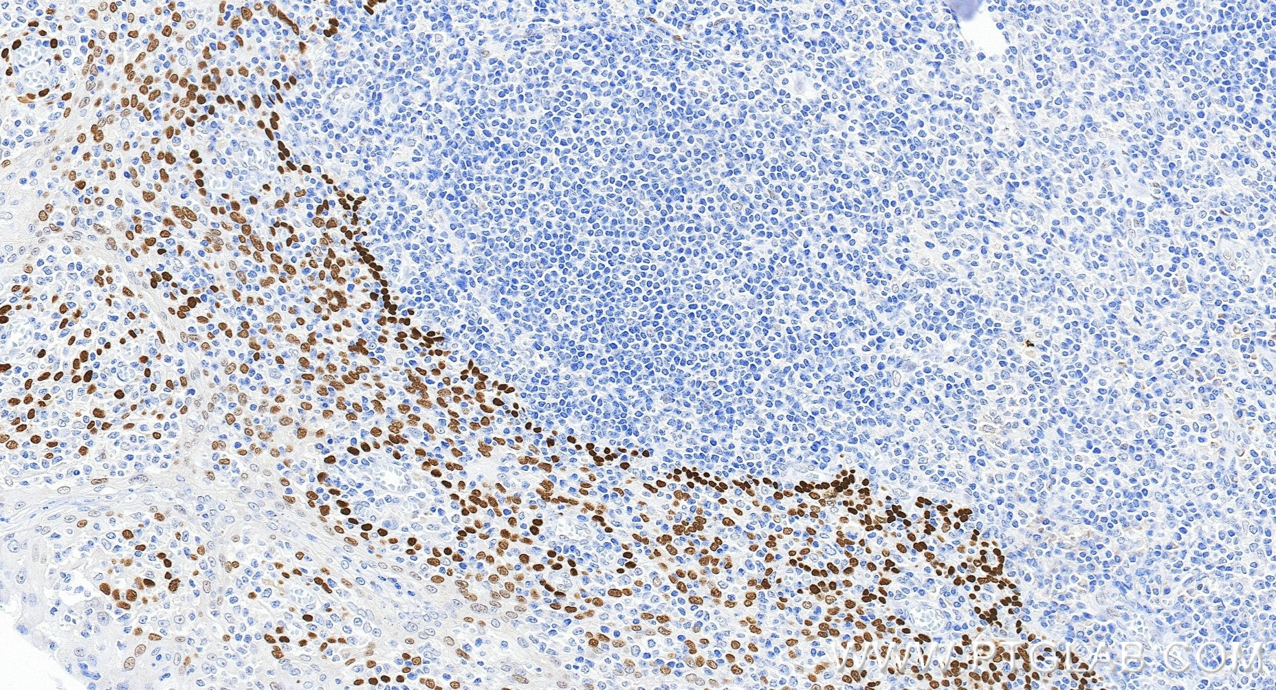 Immunohistochemistry (IHC) staining of human tonsillitis tissue using TP63 Recombinant monoclonal antibody (86154-1-RR)