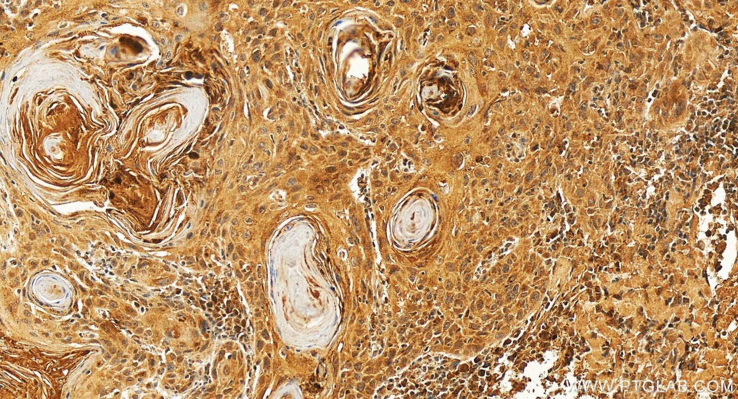 Immunohistochemistry (IHC) staining of human skin cancer tissue using TP73 Polyclonal antibody (27688-1-AP)